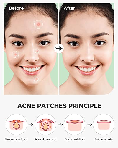 MAPPERZ Acne Pimple Patch Facial Stickers cover with 100% Hydrocolloid ( Invisible Acne Pimple Patch)
