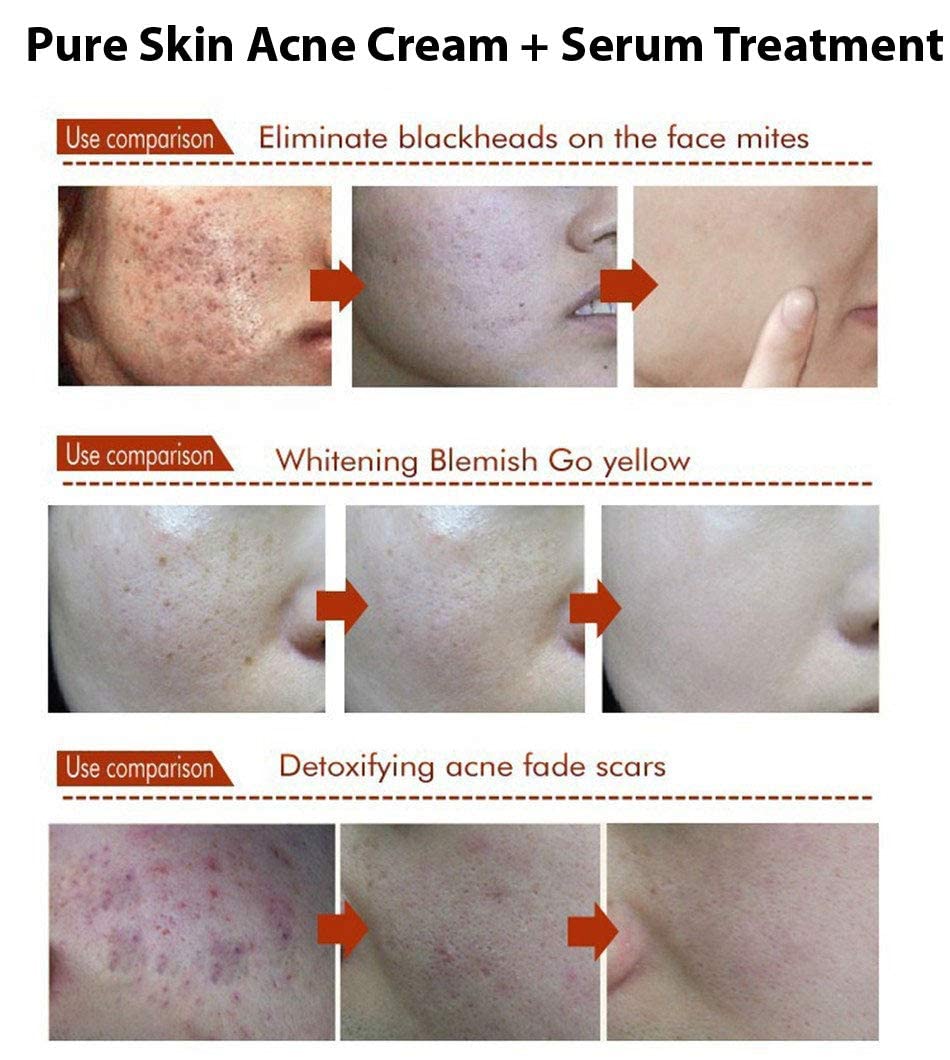 MAPPERZ | AquaBioaqua Face Care Acne Treatment Acne Treatment Cream Shrink Pores Oil Control Skin Care 30gm