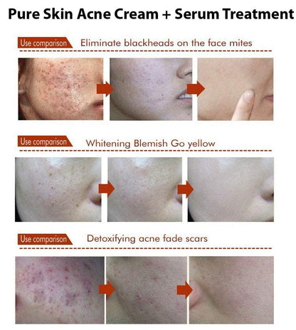 MAPPERZ | AquaBioaqua Face Care Acne Treatment Acne Treatment Cream Shrink Pores Oil Control Skin Care 30gm