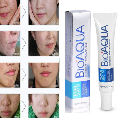 MAPPERZ | AquaBioaqua Face Care Acne Treatment Acne Treatment Cream Shrink Pores Oil Control Skin Care 30gm