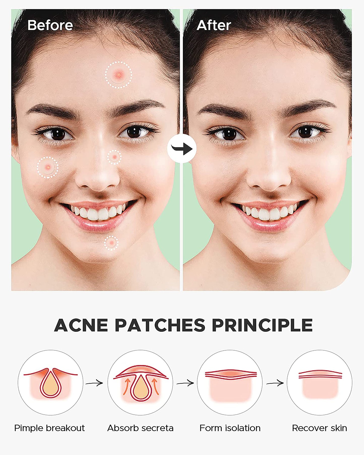 MAPPERZ Acne Pimple Patch Facial Stickers cover with 100% Hydrocolloid- (36 Invisible Acne Pimple Patch)