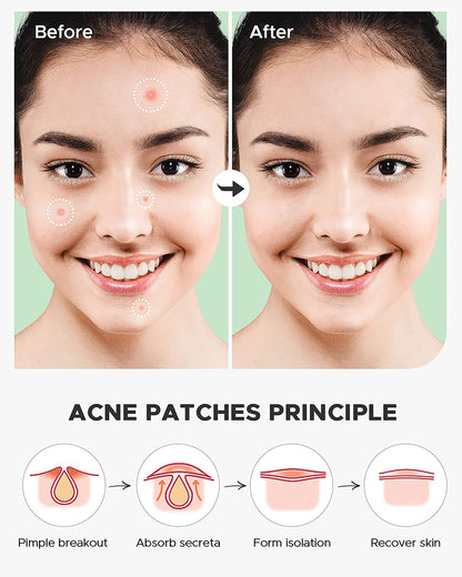 MAPPERZ Acne Pimple Patch Facial Stickers cover with 100% Hydrocolloid- (36 Invisible Acne Pimple Patch)